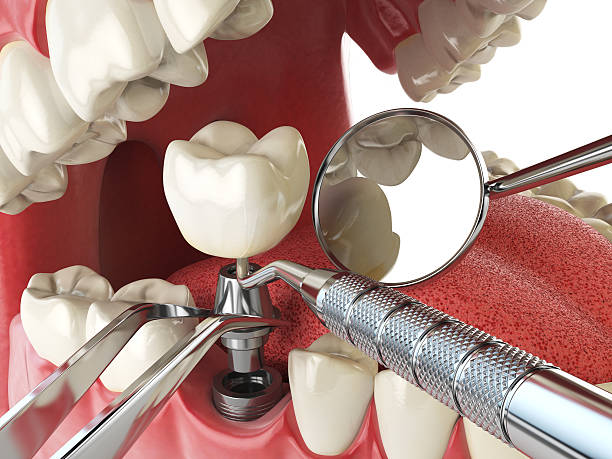 Best Emergency Dentist for Lost Fillings or Crowns in Littlerock, CA